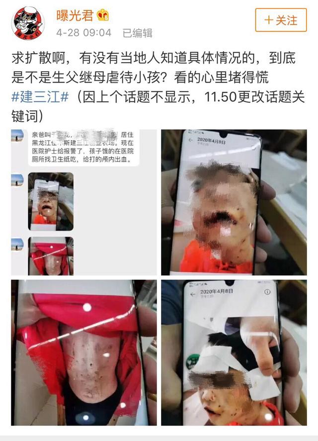 女童：哈尔滨市儿童医院：被虐女童有生命危险 全院会诊中