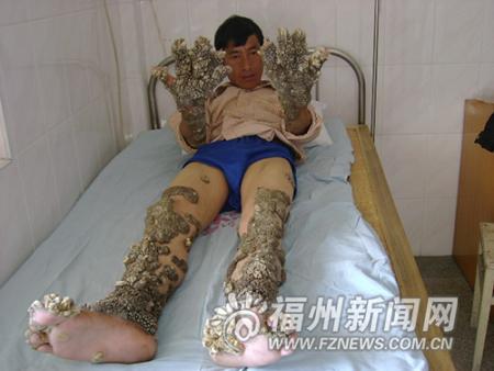 这种疙瘩不仅长在皮肤表面