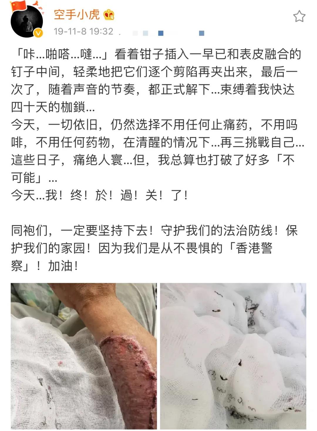港警“小虎Sir”解开纱布的这幕，太心疼！