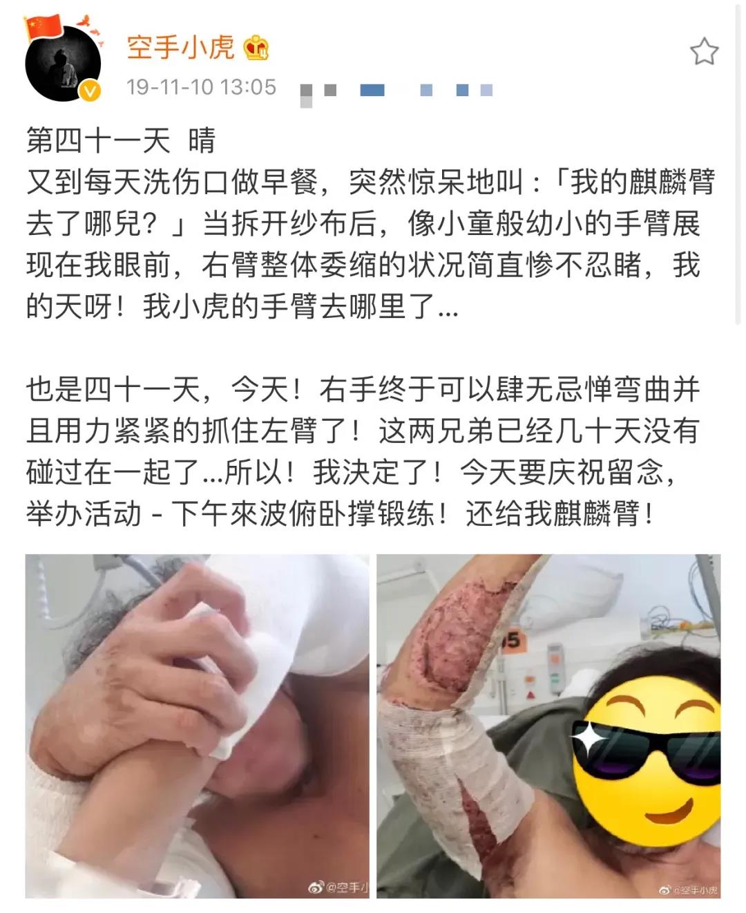 港警“小虎Sir”解开纱布的这幕，太心疼！