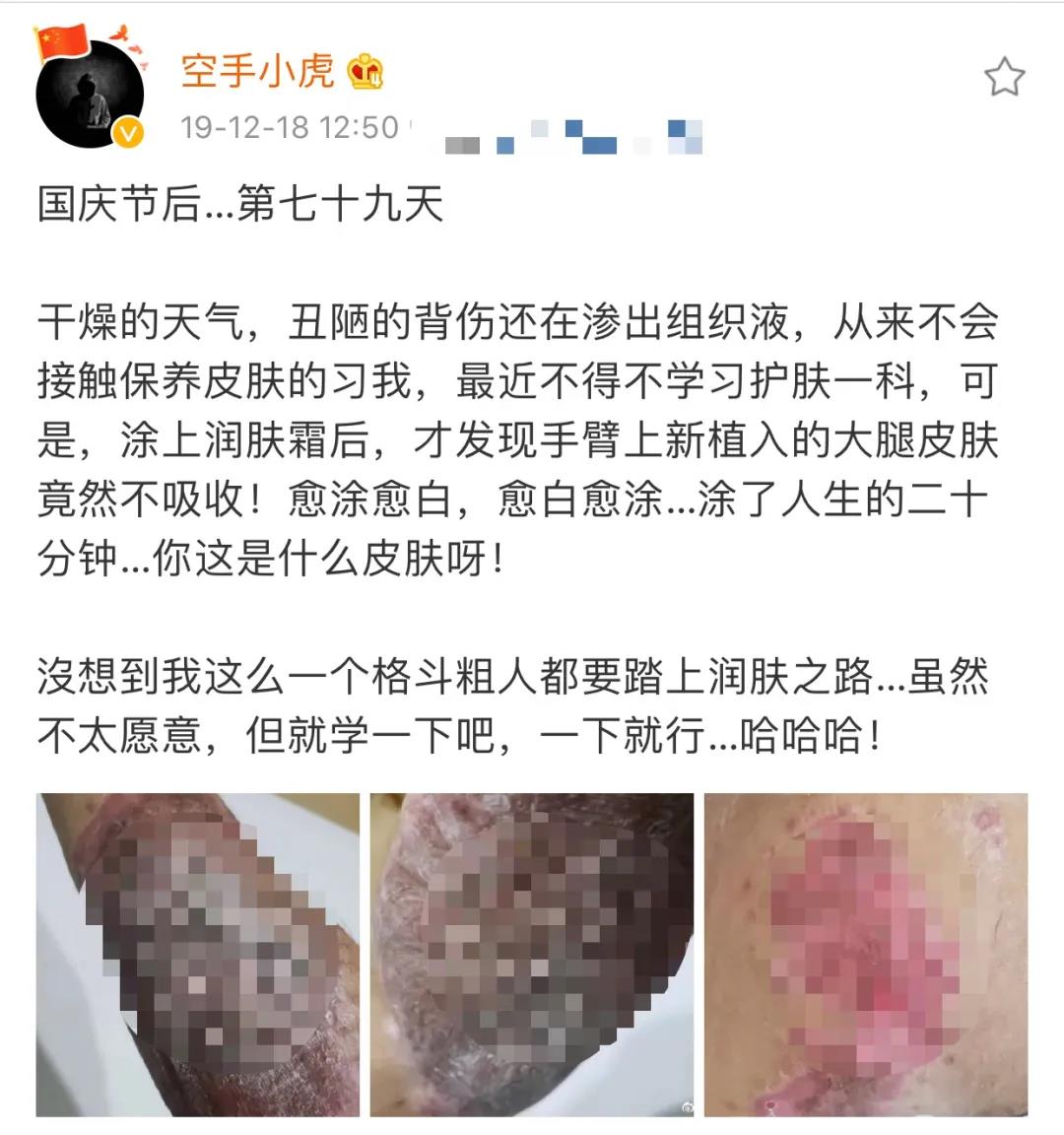 港警“小虎Sir”解开纱布的这幕，太心疼！