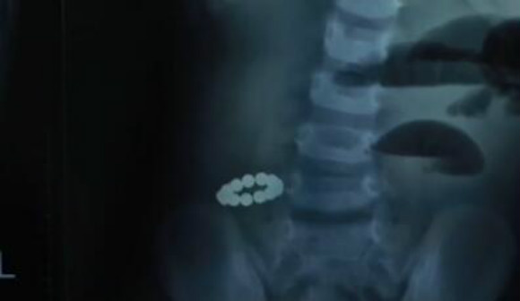 3岁女孩误吞13颗磁力珠半昏迷!家长一定要当