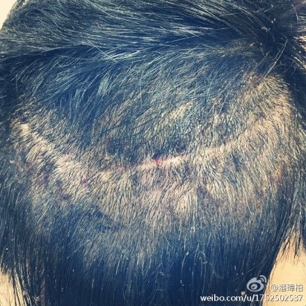 潘玮柏晒头部伤口照乐观面对：头顶画个微笑（图）