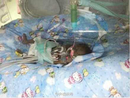 中国最小早产婴筷子宝宝仅存活19天 还是走