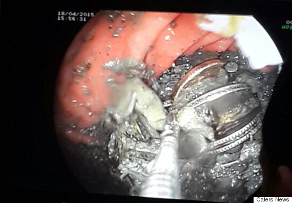 印度农民因胃疼去检查 医生从其胃中取出大量