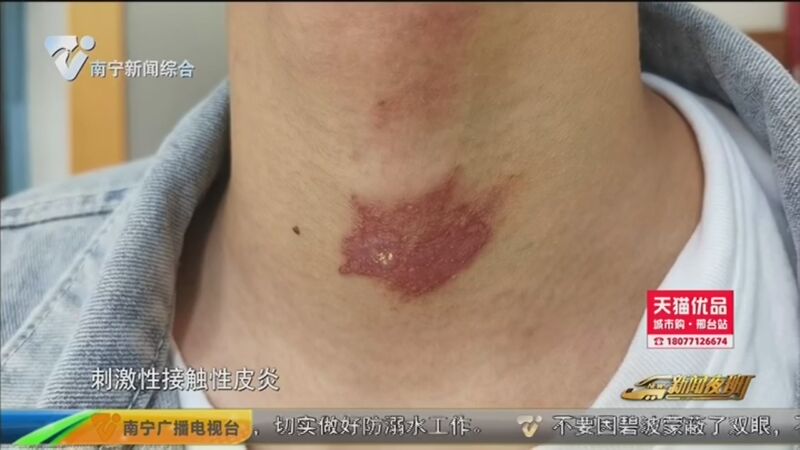 [新闻夜班]一个宿舍全部"中招" 隐翅虫间接接触也可能发生感染