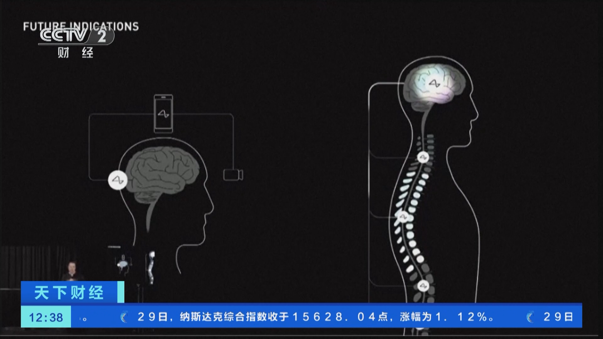 天下财经]马斯克旗下公司完成首例脑机接口设备人体移植
