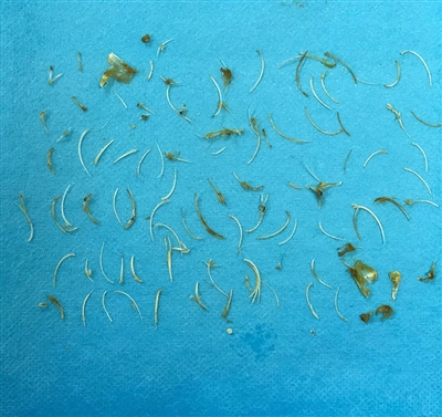 六旬独居老翁喝鲫鱼汤不吐刺 上百根鱼刺扎直肠