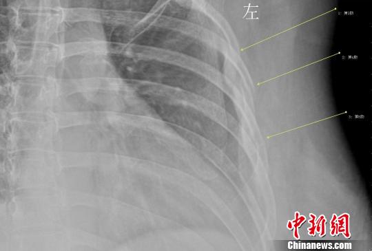 女白领咳断3根肋骨把咖啡当水喝导致骨质疏松